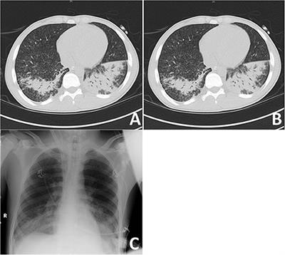 Case Report: Eculizumab and ECMO Rescue Therapy of Severe ARDS in Goodpasture Syndrome